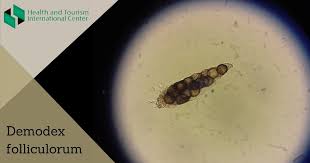 Image result for Demodex folliculorum