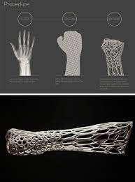 Cortex A Conceptual 3d Printed Exoskeletal Cast By Jake Evill Medical Design Prosthetics Prints
