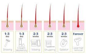 It's only about 10 percent every appointment and you can't wax while you do it. Igbeauty Is Laser Hair Removal Permanent