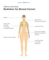 We know that strong radiation causes hair loss, but can phone radiation cause hair loss? Side Effects Of Radiation Therapy For Breast Cancer What You Need To Know