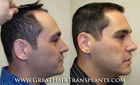 Womens Hair Transplant Surgery in Texas Grayson Howe
