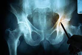 Damage to the lower spine can cause referred pain in the hip, even if the hip is in top condition. Is It Back Pain Or Hip Pain Getting To The Root Of The Problem