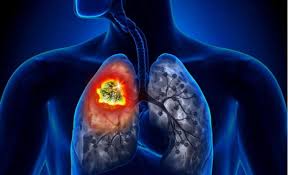 Approximately 224,390 new cases (117,920 in men and 106,470 in women) with. 5 Facts About Lung Cancer Medanta