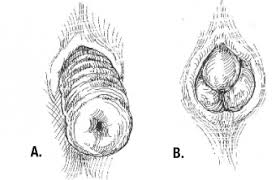 Image result for Rectal prolapse