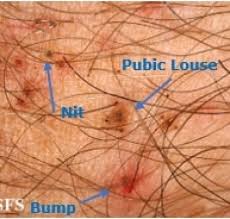 Image result for pubic lice symptoms