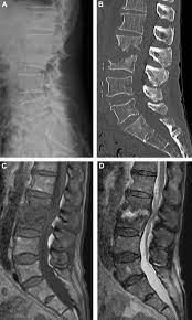 Diagnosis And Management Of Spinal Infections Sciencedirect