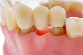 Meski harga gigi palsu permanen geraham cukup tinggi, produk ini dirancang mirip dengan aslinya sehingga membuat nyaman. Pasang Gigi Palsu Murah Di Jakarta Audy Dental