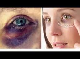 1 How To Get Rid Of A Black Eye Fast Youtube Black Eye Remedies Eye Black Skin Makeup