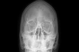 Image result for Sinus X Ray