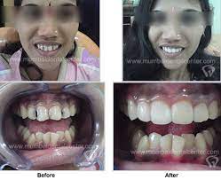 In Cosmetic Dentistry Our Dentist In Mumbai India Offers All Kinds Of Dental Cosmetic Procedures Like Tooth Colo Dentistry Dental Cosmetics Cosmetic Dentistry