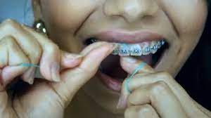 How to brush your teeth with braces wikihow. How To Brush Your Teeth With Braces On With Pictures Wikihow