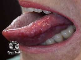 Image result for lichen planus on tongue)