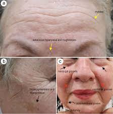 Aging Skin and Anti-aging Strategies