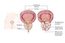 Kanker prostat merupakan keganasan yang disebabkan oleh tumbuhnya sel abnormal di bagian kelenjar prostat pria, kelenjar pada sistem reproduksi yang . Bph Benign Prostatic Hyperplasia Gejala Penyebab Dan Mengobati Alodokter