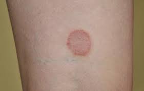 Ringworm is caused by a worm probably the most pervasive ringworm myth, this one stems from the. How Long Does It Take For Ringworm To Clear Up