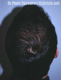 Le manifestazioni dell'alopecia androgenetica risultano diverse nei due sessi. Trapianto Di Capelli Il Reinfoltimento Della Zona Posteriore Vertex Calvizie Net