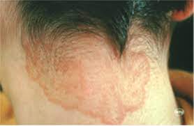 Do hand sanitizers actually work at killing disease causing microbes? Ringworm Downers Grove Il Dermatologist