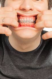 Welcome to the braces minute, where orthodontist dr. Pain Relief For Sore Lips Cheeks Or Tongues From Braces