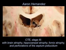 According to the boston university cte center , chronic traumatic encephalopathy (cte) is a degenerative brain disease found in athletes, military veterans, and others. New Images Show Aaron Hernandez Suffered From Extreme Case Of Cte Nfl The Guardian