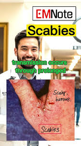 Image result for scabies transmission