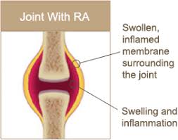 What Is Rheumatoid Arthritis