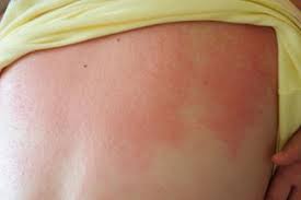 Itchy skin at night without any rash is often a sign of an internal condition. Rashes In Babies And Children Nhs