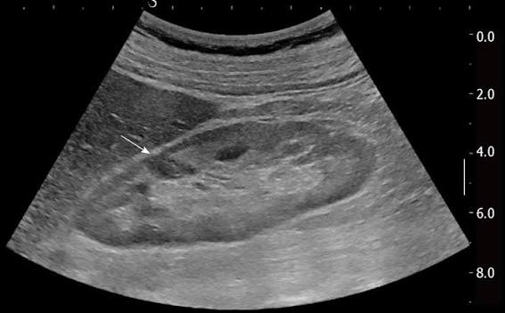 Hypoechoic lesion of the kidney that was revealed as focal nodule from... |  Download Scientific Diagram