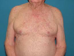 Image result for sweat rash on back