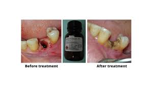 Image result for Post-Tooth Extraction Bleeding