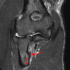 During this time, you won't feel anything happening. Distal Biceps Tendon Rupture Elbow Radsource