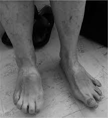 Journal Of Rehabilitation Medicine Botulinum Toxin For Foot Dystonia In Patients With Parkinson S Disease Having Deep Brain Stimulation A Case Series And A Pilot Study Html