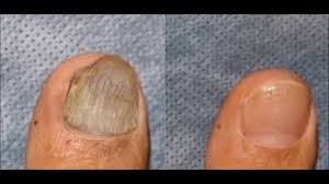 how serious is toenail fungus anese