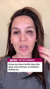 Christy Carlson Romano's Eye Injury During Clay Shooting