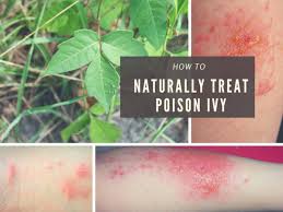 Poison ivy pictures on skin. A Natural And Fast Poison Ivy Cure Remedygrove