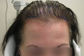 This kind of dream represents your concerns about growing older and starting a new phase in life. What Does Bald Spots In Dreams Mean