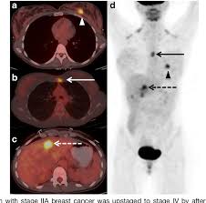 Ct scans are most often an outpatient procedure. The Evolving Role Of Fdg Pet Ct In The Diagnosis Staging And Treatment Of Breast Cancer Semantic Scholar