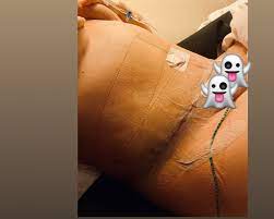 Buikwandcorrectie Kosten Meer Informatie Kliniekervaringen Nl