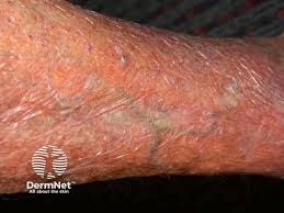 Image result for Systemic Corticosteroid