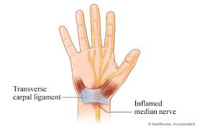 Image result for Carpal Compression Test
