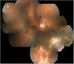 Image result for HIV Retinitis