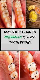 But if the tooth decay process continues, more minerals are lost. Wow 6 Amazing Ways To Heal Tooth Decay And Reverse Cavities Naturally