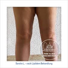 Lipodem Park Klinik Birkenwerder Bei Berlin