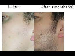 Run your hands under cold water right if you experience any dryness after using minoxidil, then start a beard oil routine, which can. Briliant Brain Minoxidil Before And After Beard Result Minoxidil Beard Week 16 1 Month Of Growth Youtube It S Important To Note That Using 5 Versus 2 Will Not Necessarily Give