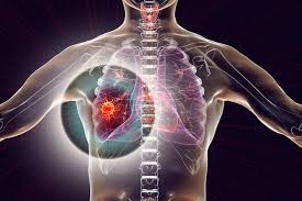 Some people have symptoms related to the lungs. Lung Cancer Patients Living In Rural Areas Uninsured Or On Medicaid Less Likely To Get Recommended Treatment Hsc News