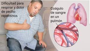 La trombosis, formación de un coágulo en las arterias, es la enfermedad responsable del 25% de las muertes en méxico. Una Embolia Pulmonar Agencia De Enfermeria Nightingale Facebook