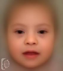 Epicanthic folds is a skin fold on the upper eyelid which covers the inner angle of the eye, which makes them appear smaller and more slanted, even if the eye itself is no different from an eye with no epicanthic fold. Eye Folds Symptom Of A Rare Disease Or Genetic Syndrome
