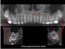 Pdf) Management Of Supernumerary Teeth In Children: A Narrative Overview Of  Published Literature | Sivakumar Nuvvula - Academia.Edu
