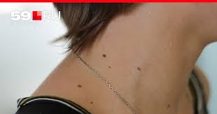 Kak Otlichit Raka Kozhi Ot Melanomy I Mozhet Li Rodinka Stat Prichinoj Raka 59 Ru Novosti Permi