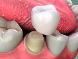 Metal destekli kaplamalar bazı kliniklerde ve devlet hastanelerinde, sigorta katkısı ile yapılabilmektedir, estetik diş kaplamaları ise kozmetik bir prosedür olarak kategorize ayrıntılı fiyat bilgisi için: Dis Kaplama Nedir Dis Kaplama Fiyatlari 2019 Confident