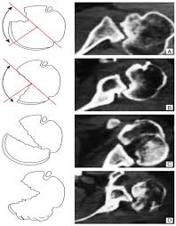 Image result for Chronic Shoulder Dislocation